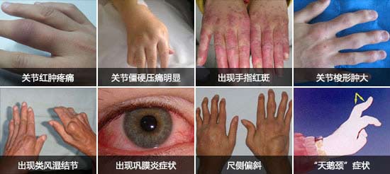 郑州痛风风湿病医院类风湿并发症.jpg