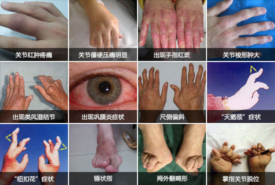 郑州痛风风湿病医院类风湿症状.jpg
