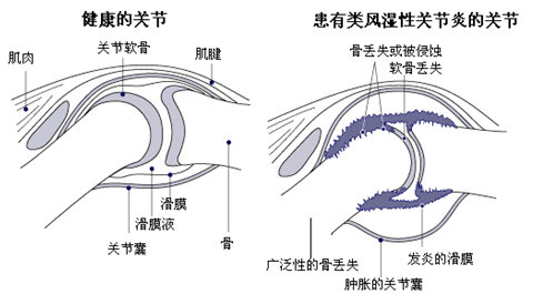 郑州痛风风湿病医院类风湿病发示意图.jpg