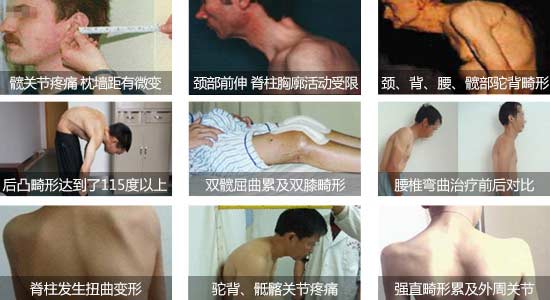 郑州痛风风湿病医院强直性脊柱炎引起脊椎弯曲、关节疼痛.jpg