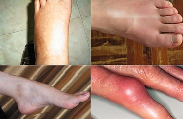郑州痛风风湿病医院手足关节痛风临床症状.jpg