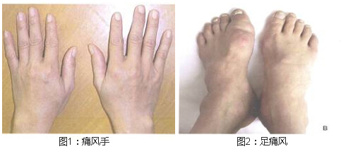 郑州痛风风湿病医院手足痛风.jpg