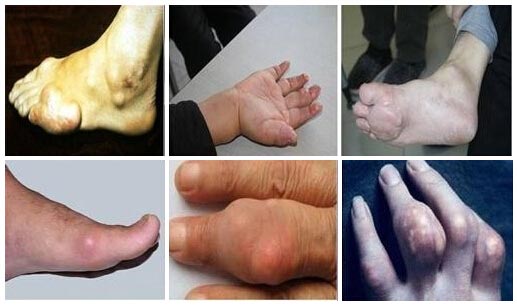 痛风症状图.jpg